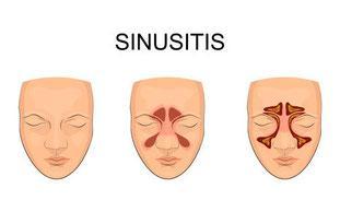 Sinusitis - eine Herausforderung für HNO Ärzte und die Naturheilkunde