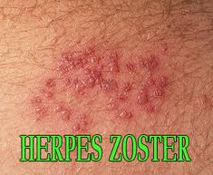 cara mengobati herpes zoster secara alami