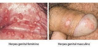 obat herpes bibir alami