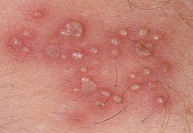 obat herpes agar cepat kering