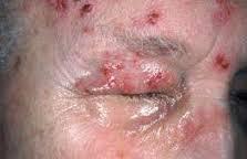 obat herpes apa