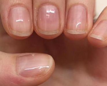 Nagelkur mit Microcell – Update Woche 1