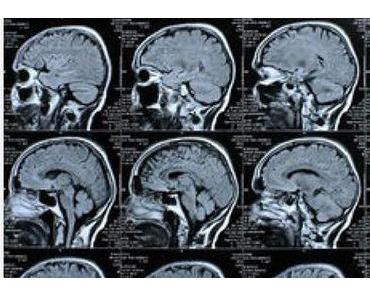 Gehirntumore: Neue, geniale Behandlung