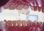 Warum tote Zähne gefährlich sind
